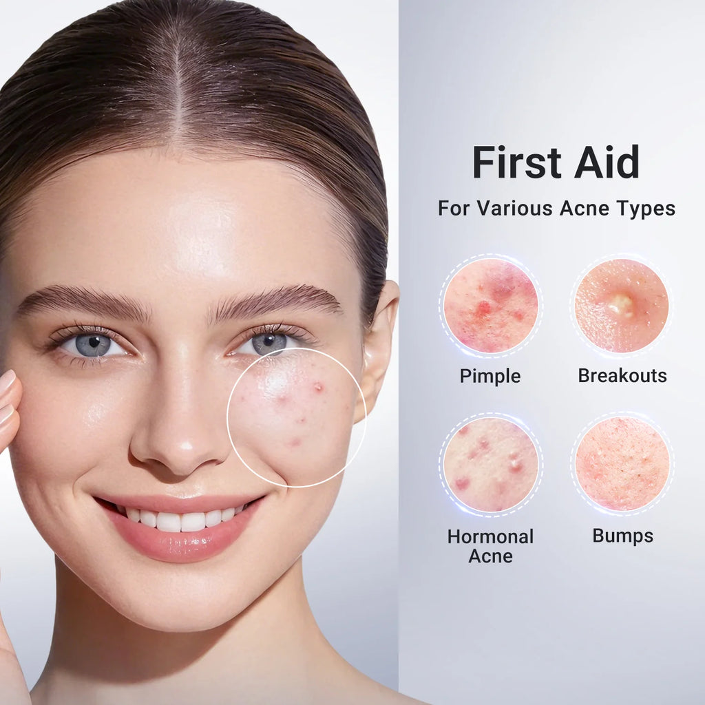 Acne Buster Plus - 1.8% Salicylic Acid Drying Lotion