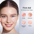 Acne Buster Plus - 1.8% Salicylic Acid Drying Lotion