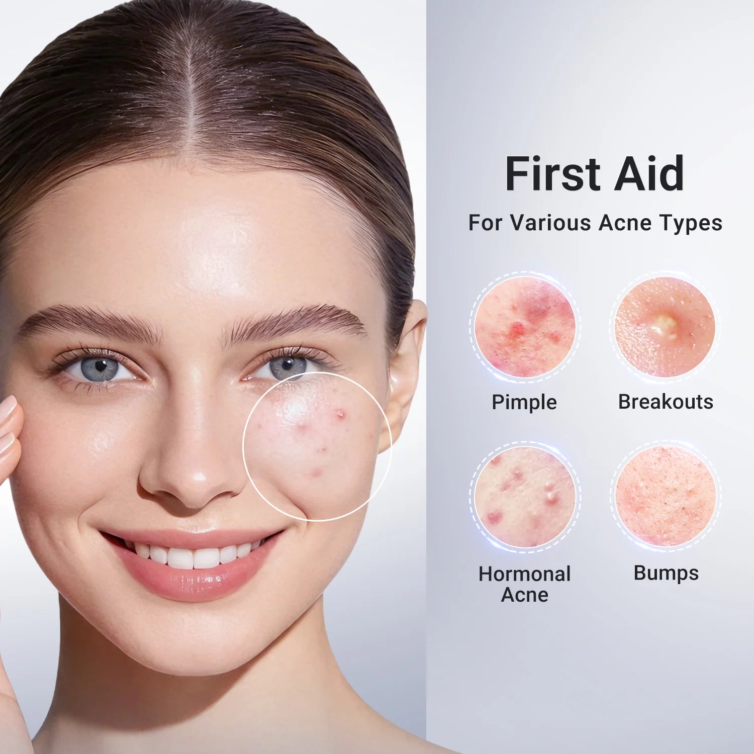 Acne Buster Plus - 1.8% Salicylic Acid Drying Lotion